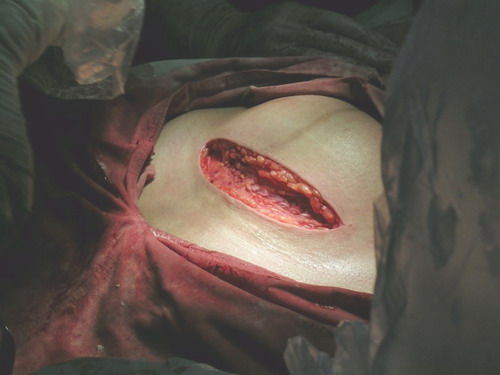 手术生孩子肚子图片