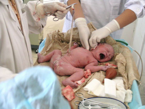 剖腹产现场实拍宝宝是如何生出来的图