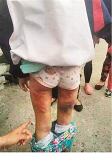 湖北7岁女孩遭后妈生父暴打致伤邻居送医警方介入