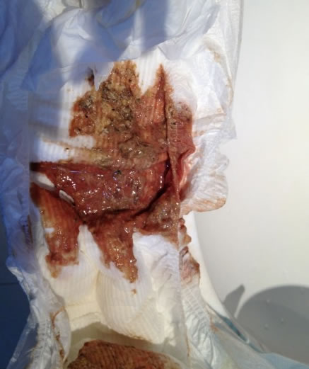 惠氏被指致北京婴儿血便,医生称疑奶粉引发肠炎