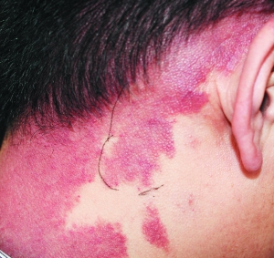 红胎记或毁脸提高警惕早治疗