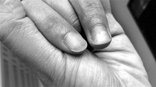 手指疼起来要命 小心甲床肿瘤