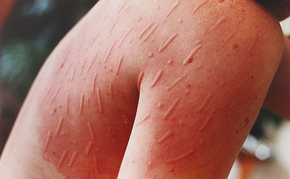 美女子患怪病敏感皮肤作画无痛感图