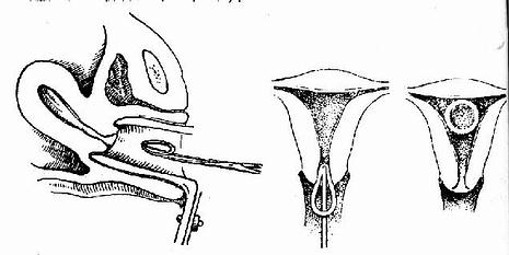 图解女性产后上环私密过程图