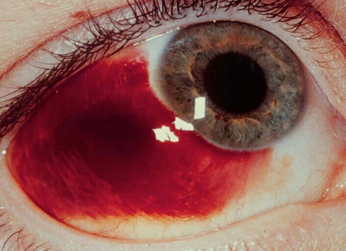 眼球毛细血管破裂图片