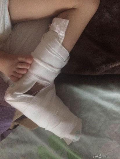 深圳一商场扶梯"咬伤"3岁女童足背伤口长8厘米