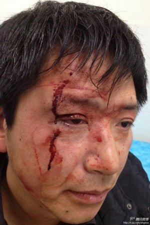 当事人李翔被殴打至右侧眼眶流血