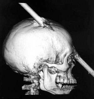 一青年被钢筋刺穿头颅 奇迹幸存