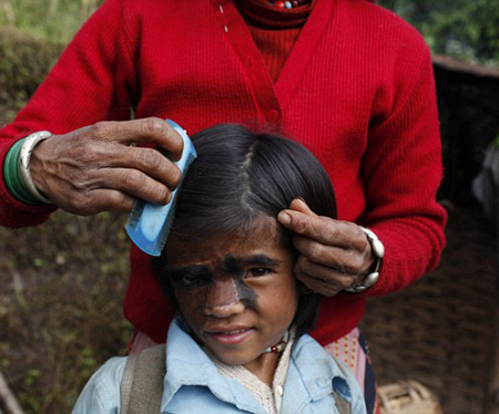 尼泊尔9岁女"毛脸孩"接受手术 曾被视作怪物(组图)